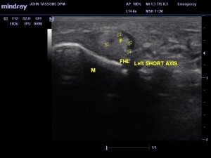 Image 3. Short axis scan sub 1. M, metatarsal head; F, flexor hallucis longus; multiple arrows, swelling in sheath; single arrow, abnormal hypoechoic area within the tendon (possible tear?).