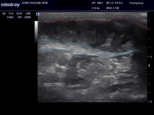 Figure 2. The plantar fascia is blue. The mass is between the red line and the fascia. Note the echogenic lines within the hypoechoic mass, consistent with a compartment-like appearance.