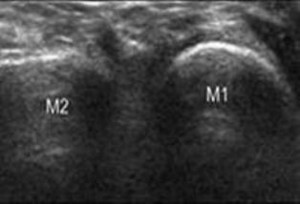 Figure 2. Coronal scan at level of metatarsals dorsally.