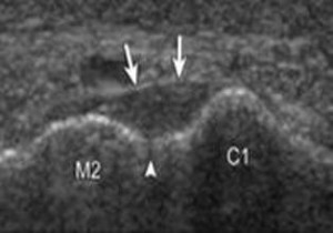 Figure 4B. Arrowhead, normal space of 1 mm; arrows, dorsal ligament; C1, medial cuneiform; M2 is second metatarsal.