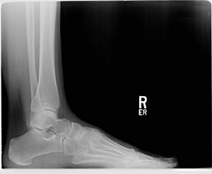 Figure 1. Lateral X-ray view of the right calcaneus with no posterior spurring noted.