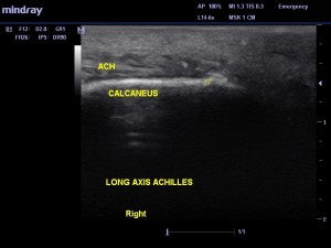 Figure 2. Arrow shows spurring arising off the posterior calcaneus.  ach = Achilles